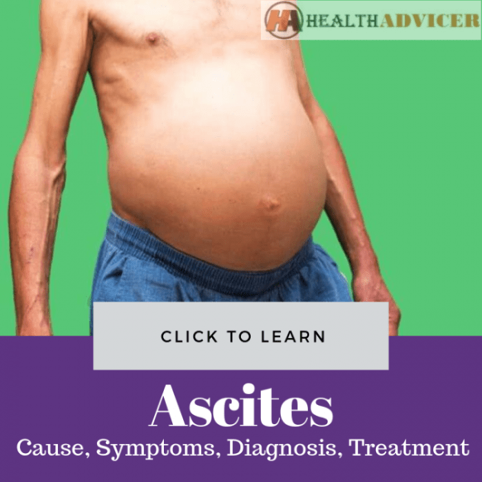 Ascites liver fattyliverdisease